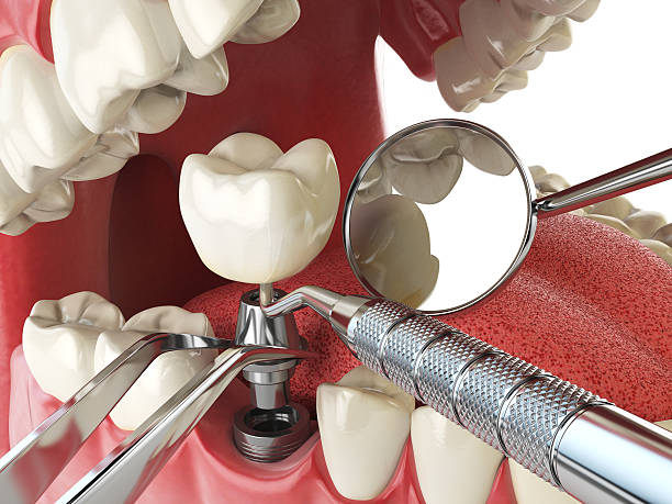Best Emergency Root Canal Treatment in Oak Ridge, FL